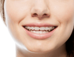 Alt text: Close-up of a smile with clear ceramic braces.